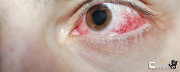 Ожог роговицы диагностирован у восьми жителей Камчатки из-за загрязнения
